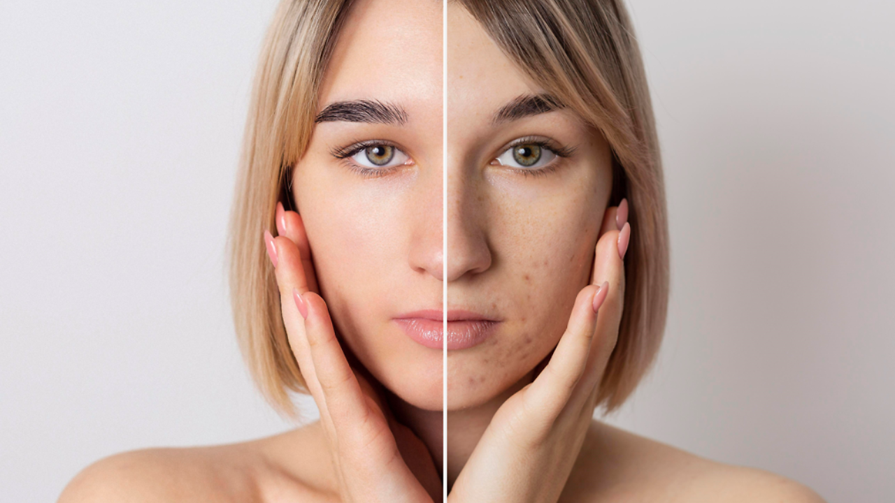 Dermatologist Shares Some Dos And Don'ts To Fix Acne | Zoom TV