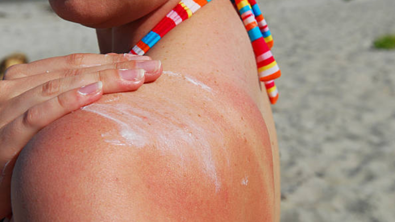 Protect Your Skin: 5 Essential Home Remedies For A Sun-Safe Beach Vacation