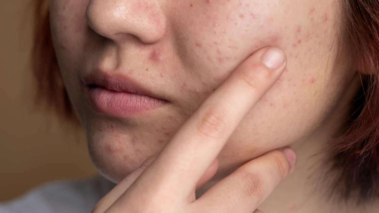 Is Rubbing Alcohol Good For Acne? Pic Credit: Freepik