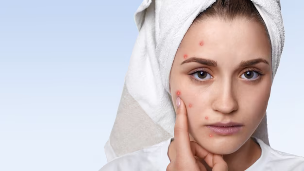 Ayurvedic remedies for pimples