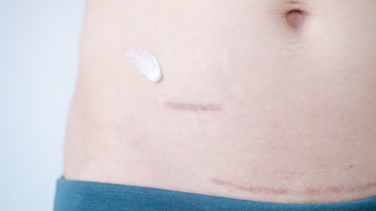 Use these 3 Ayurvedic remedies to treat C-section scars. Pic Credit: Vecteezy