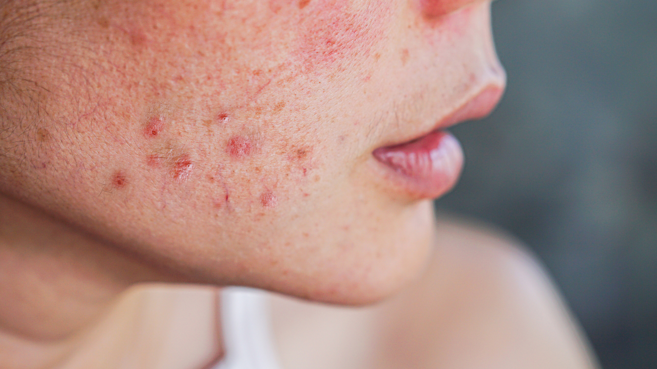 Home Remedies to Remove Acne Scars Fast