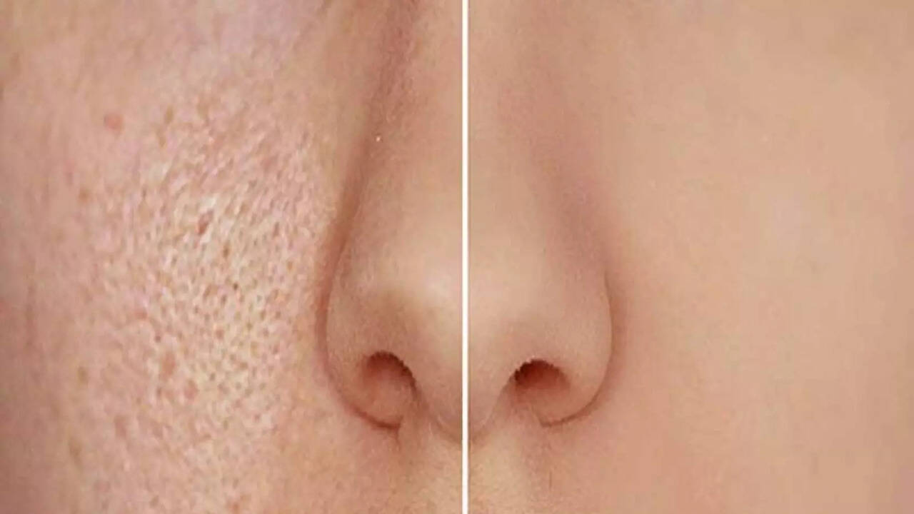 Tired Of Large Pores On Your Face? Here's How You Can Minimise Them