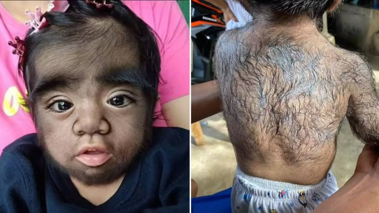 Hairiest Boy From Philippines Diagnosed With Rare 'Werewolf Syndrome'; Here's All You Need To Know About It