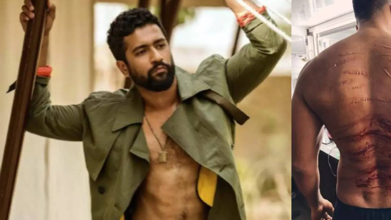 Vicky Kaushal's back heavily bruised