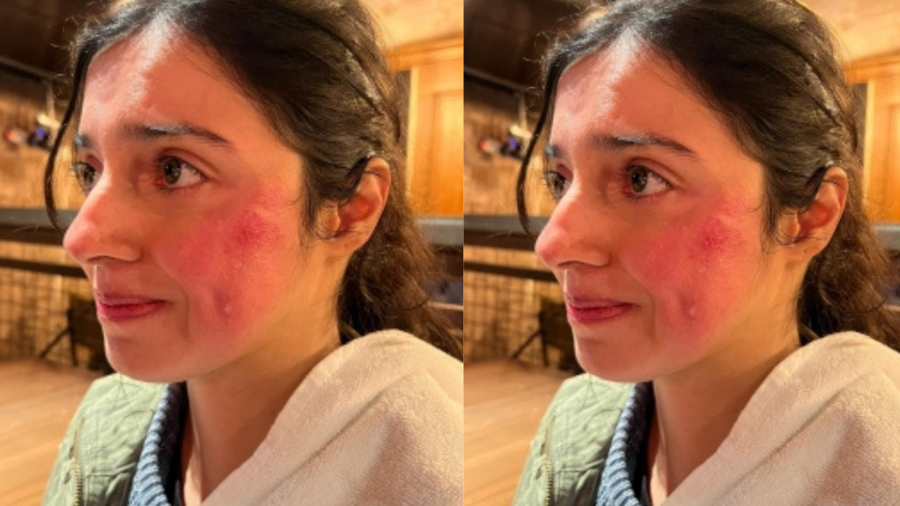 Divya Khosla Kumar gets injured while shooting an action sequence for her upcoming project. See pics