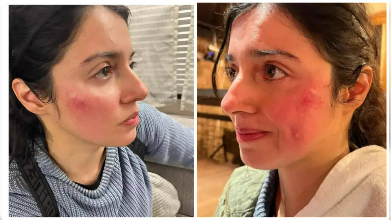 Divya Khosla Kumar Injury