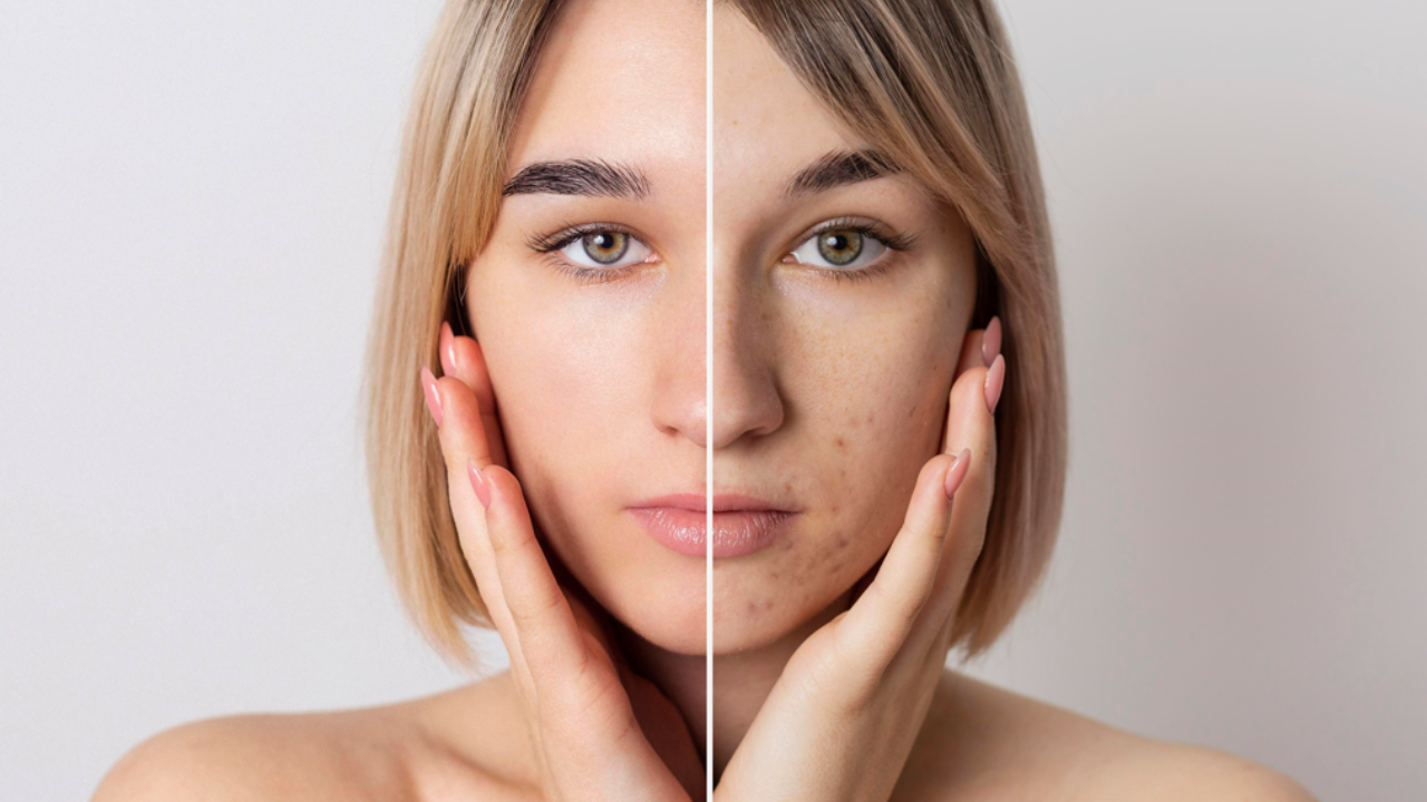 How to get rid of acne. Pic Credit: Freepik